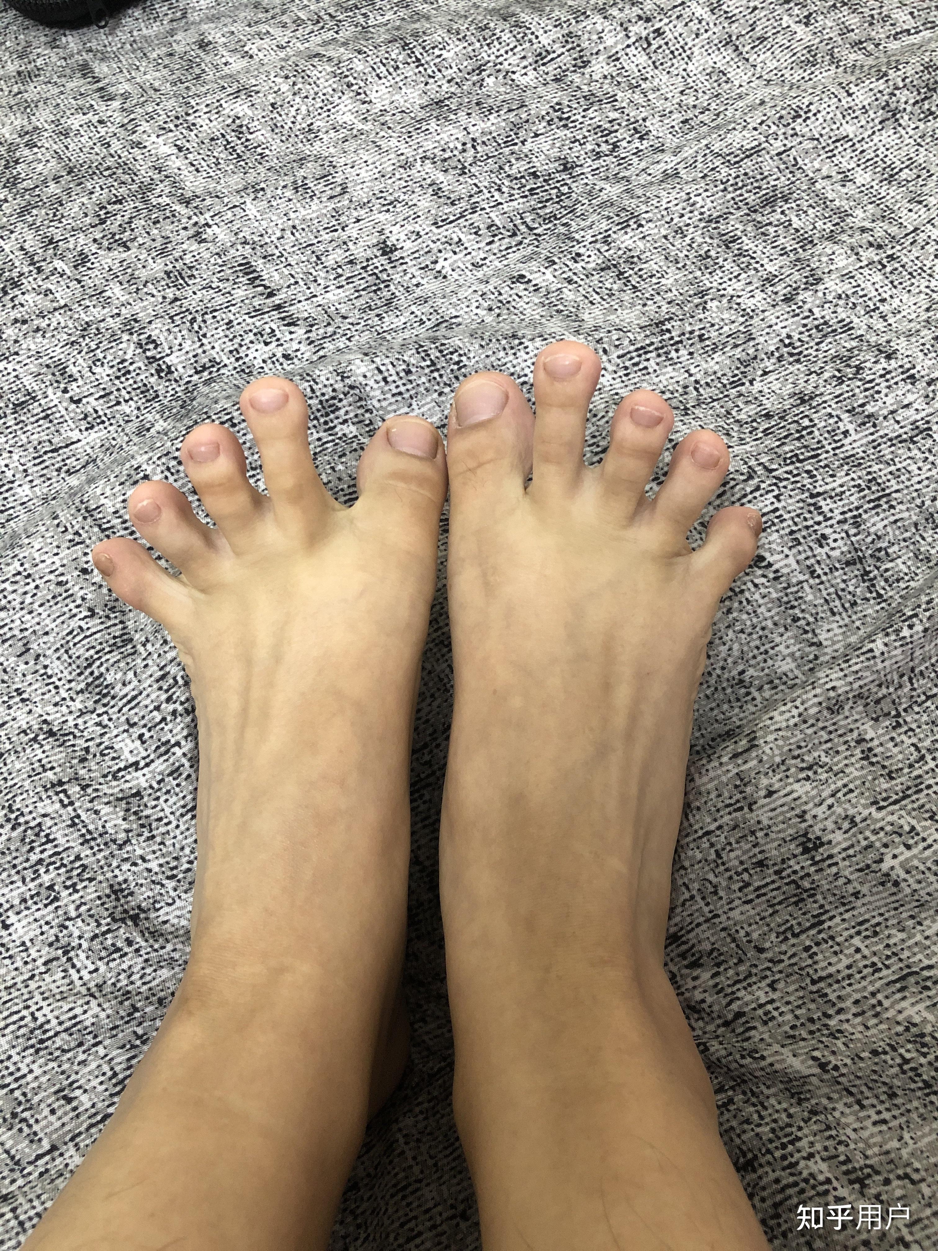 脚趾能否五指张开是基因差异吗