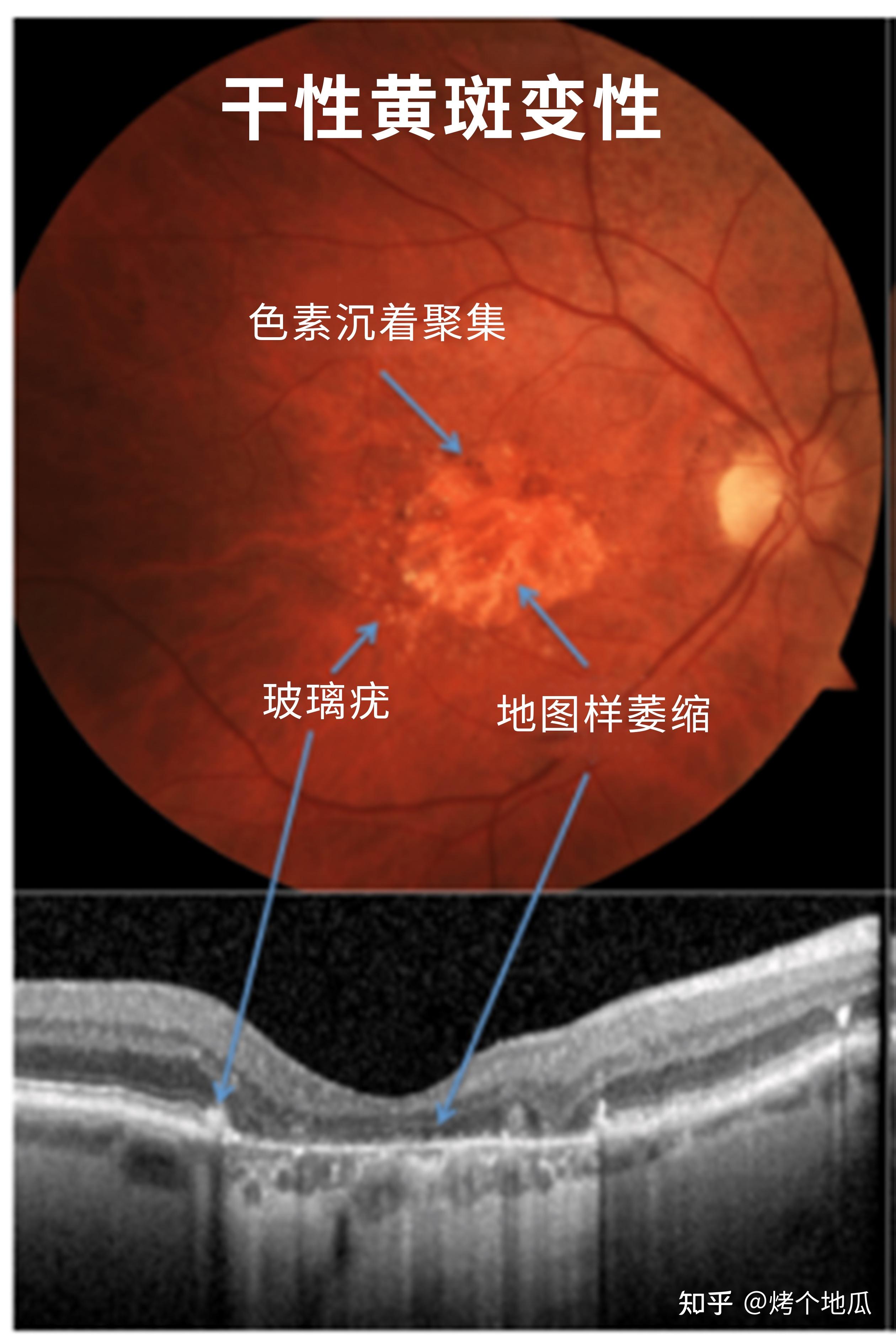 年龄相关黄斑变性有哪些症状? 