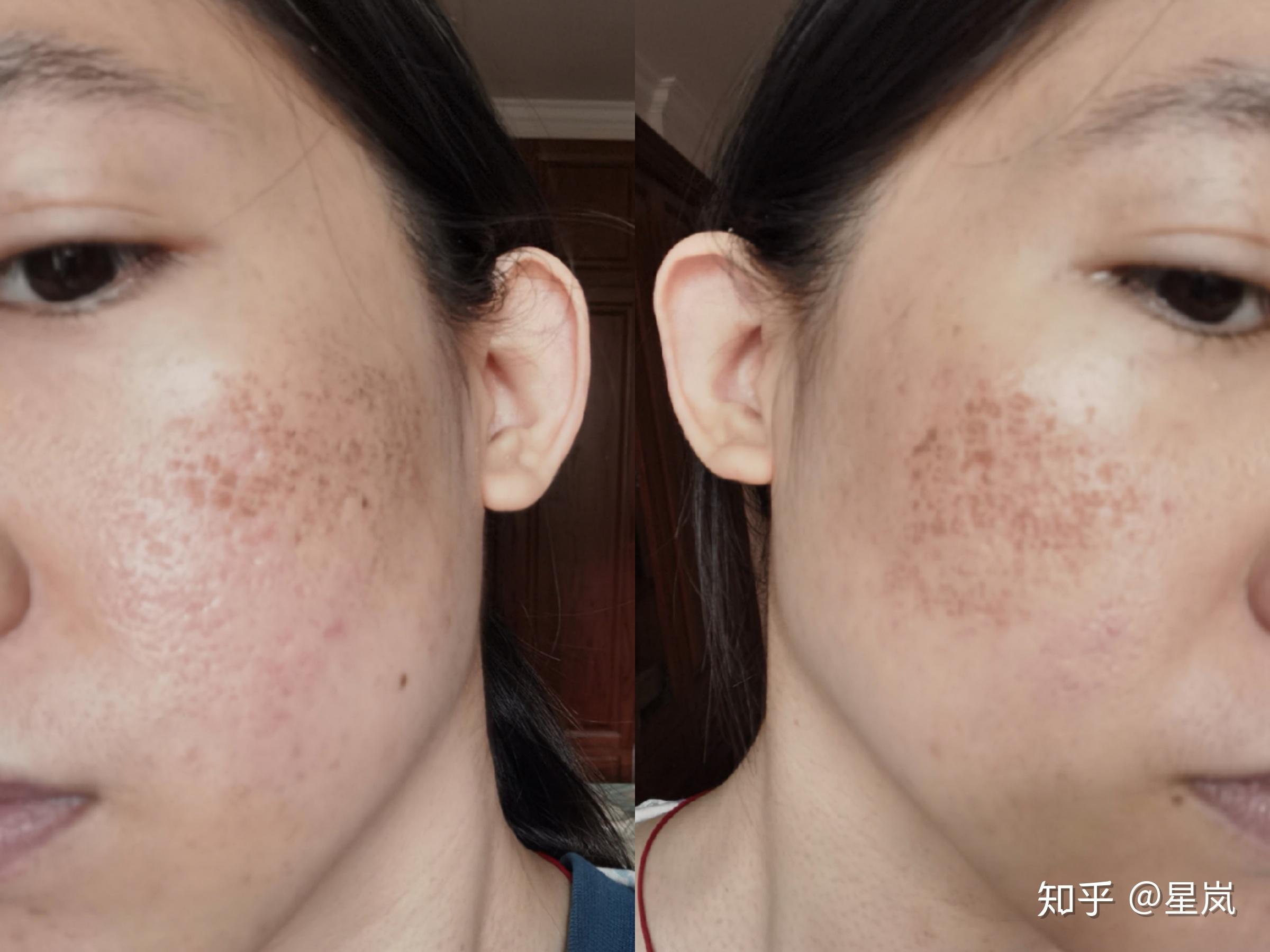 陈年痘坑怎么办plasma离子束去痘坑详细记录及前后对比持续更新