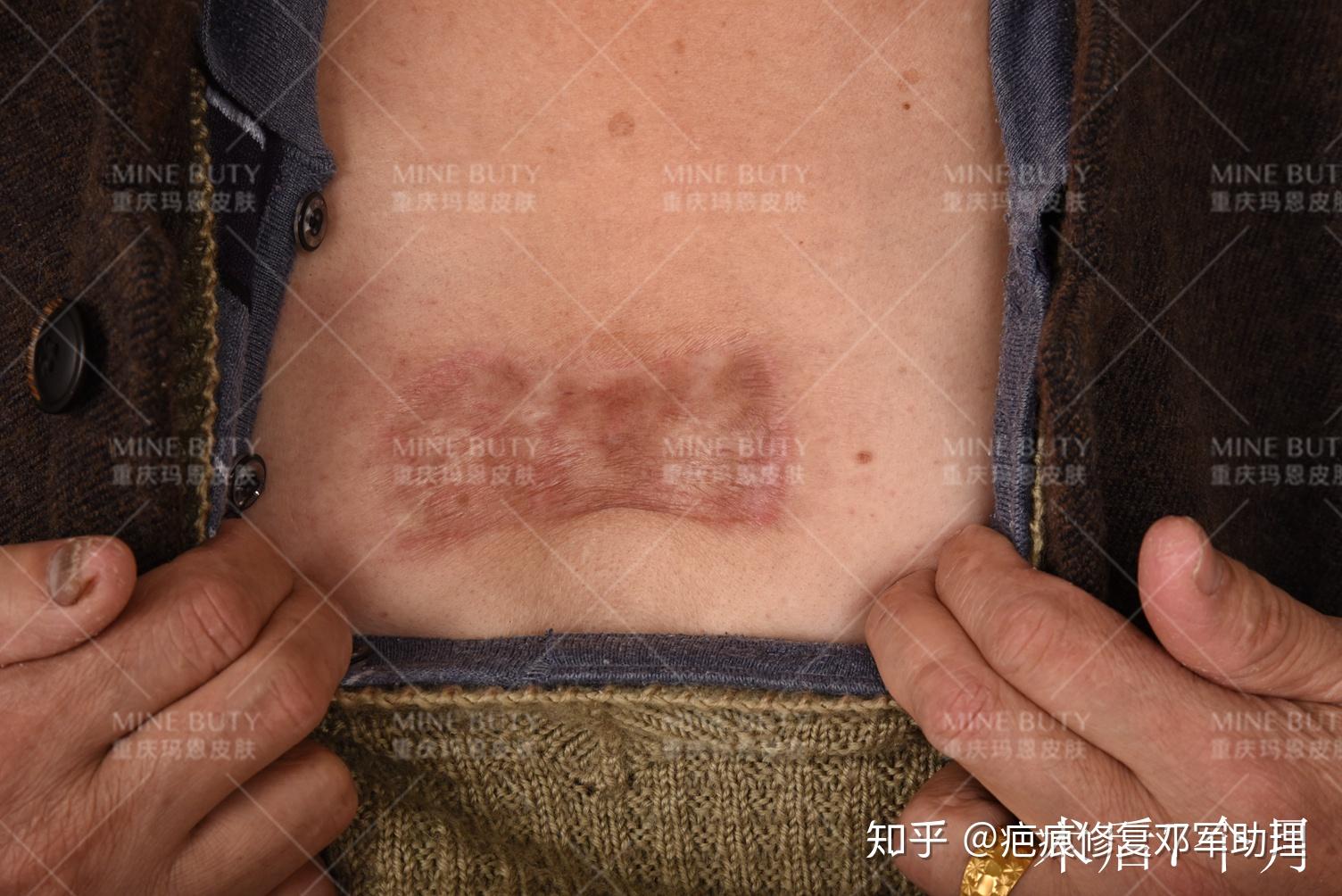 案例分享 胸前挛缩疤痕疙瘩的手术治疗 - 知乎