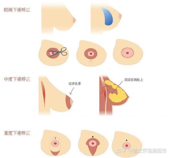 另一種是乳房塑形懸吊術,適用於輕度乳房下垂並伴有萎縮者.