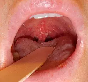 咽峡炎疱疹 初期图片