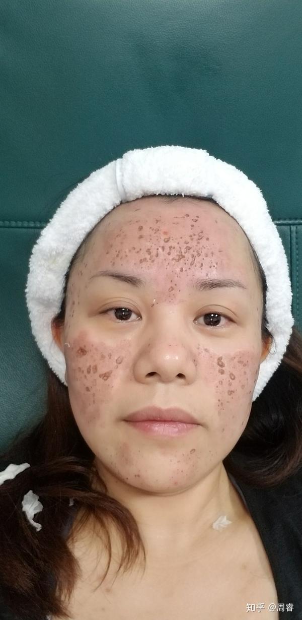 痘坑15年第一次磨削co2剥脱点阵激光记录