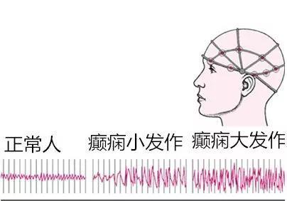 为什么癫痫病人总是要做脑电图检查不知道这些脑电图可能白做