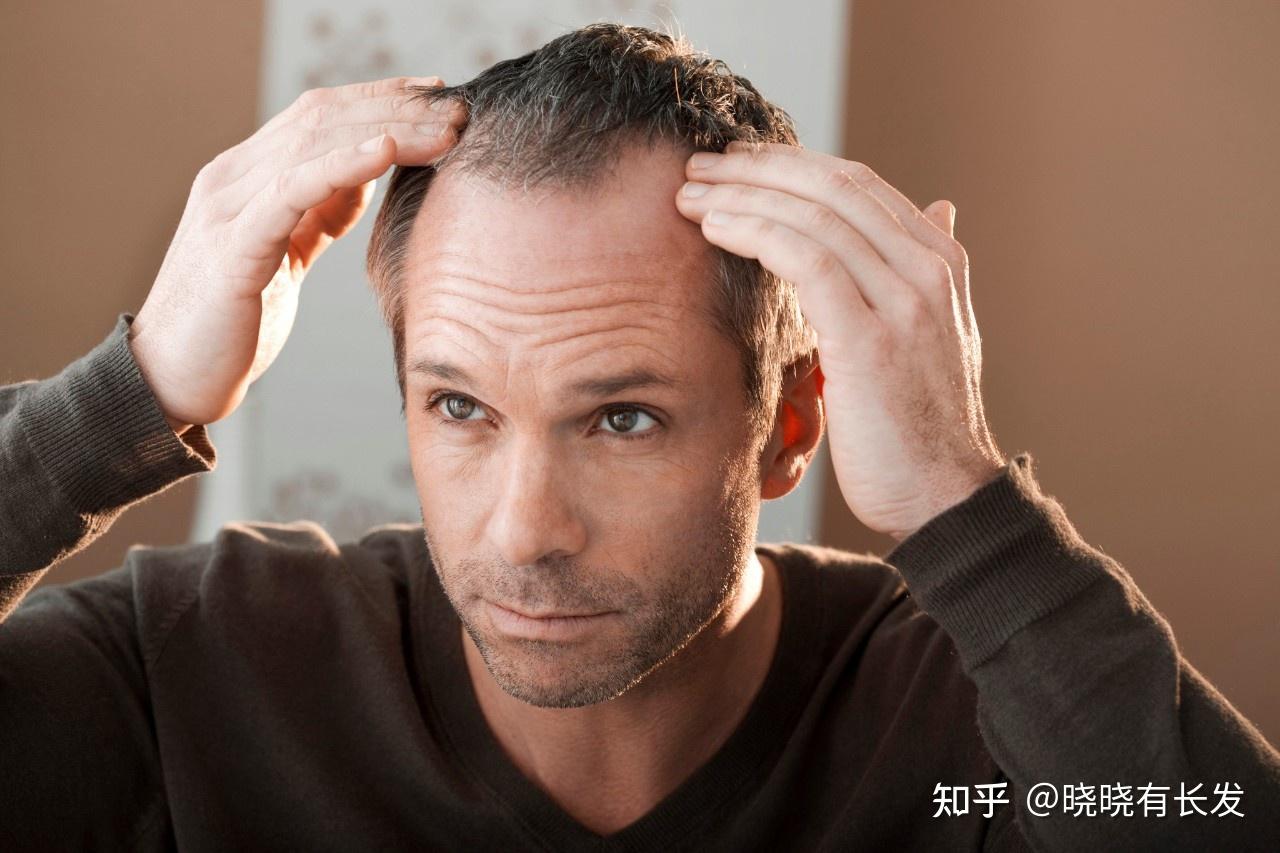 雄性激素脱发怎么治（雄性激素脱发如何治疗？） | 说明书网