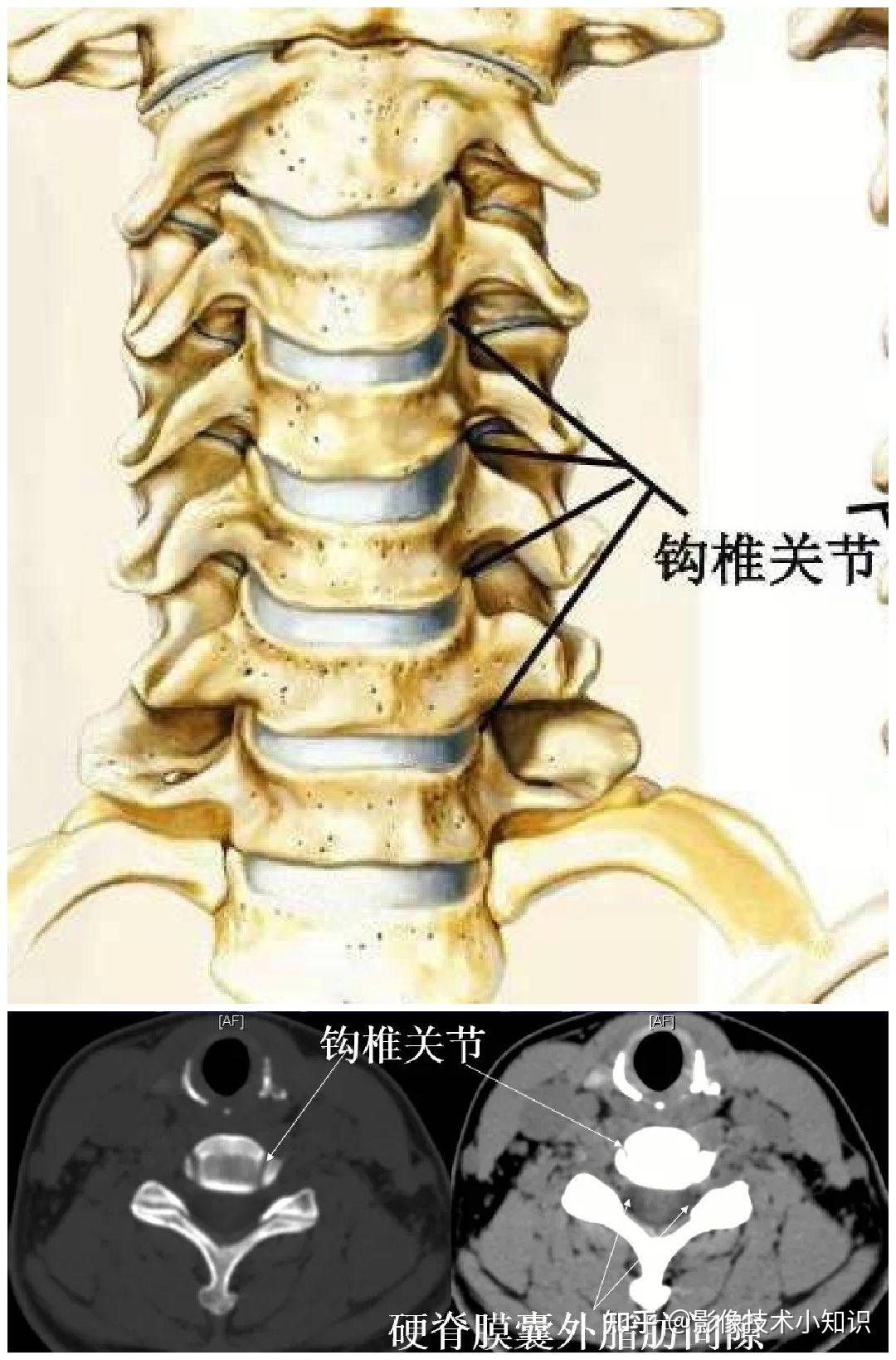 新手看胸椎ct片图解图片