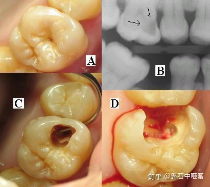 蛀牙 龋齿 Tooth decay - 知乎