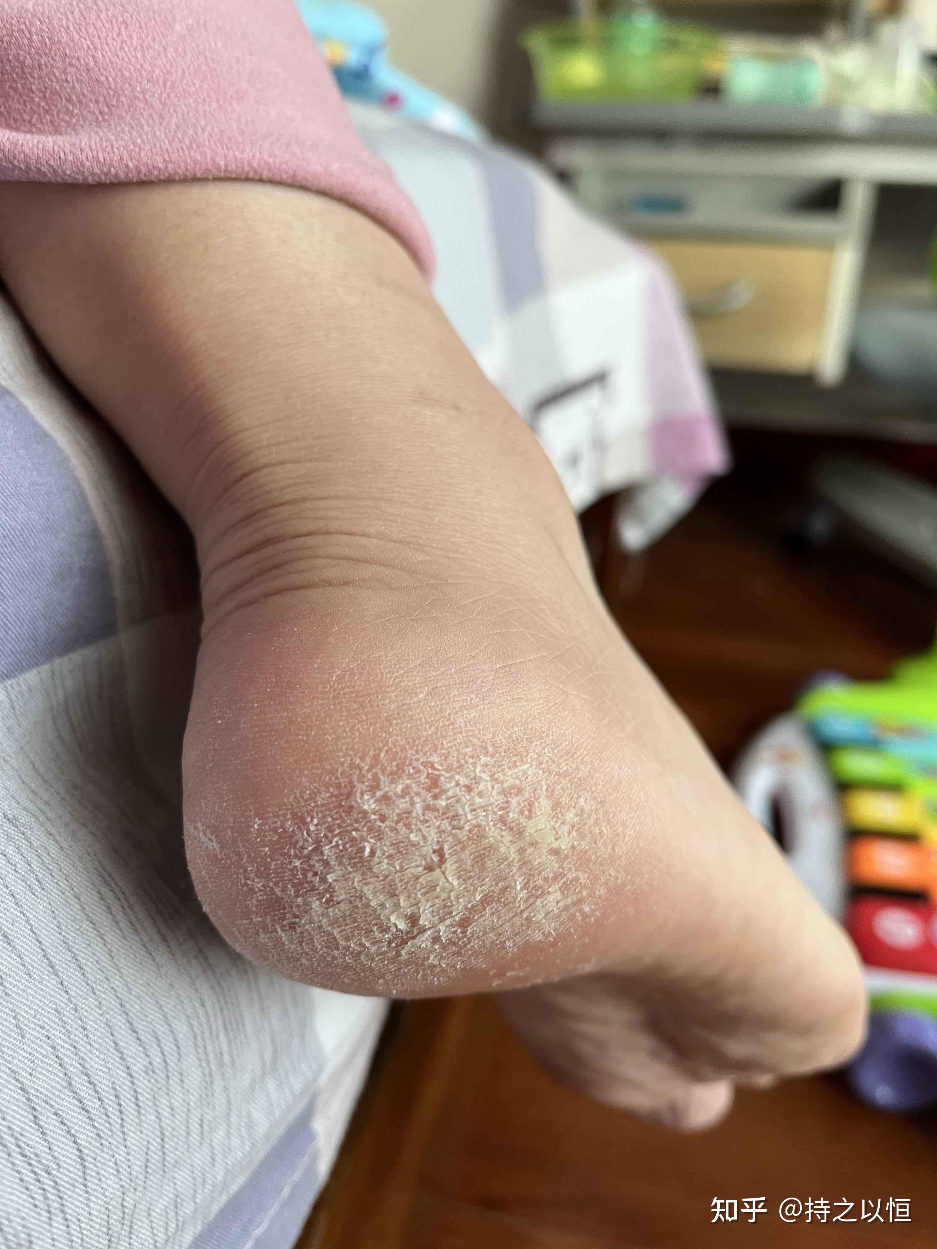 我的脚底皮这么粗糙,是为什么?