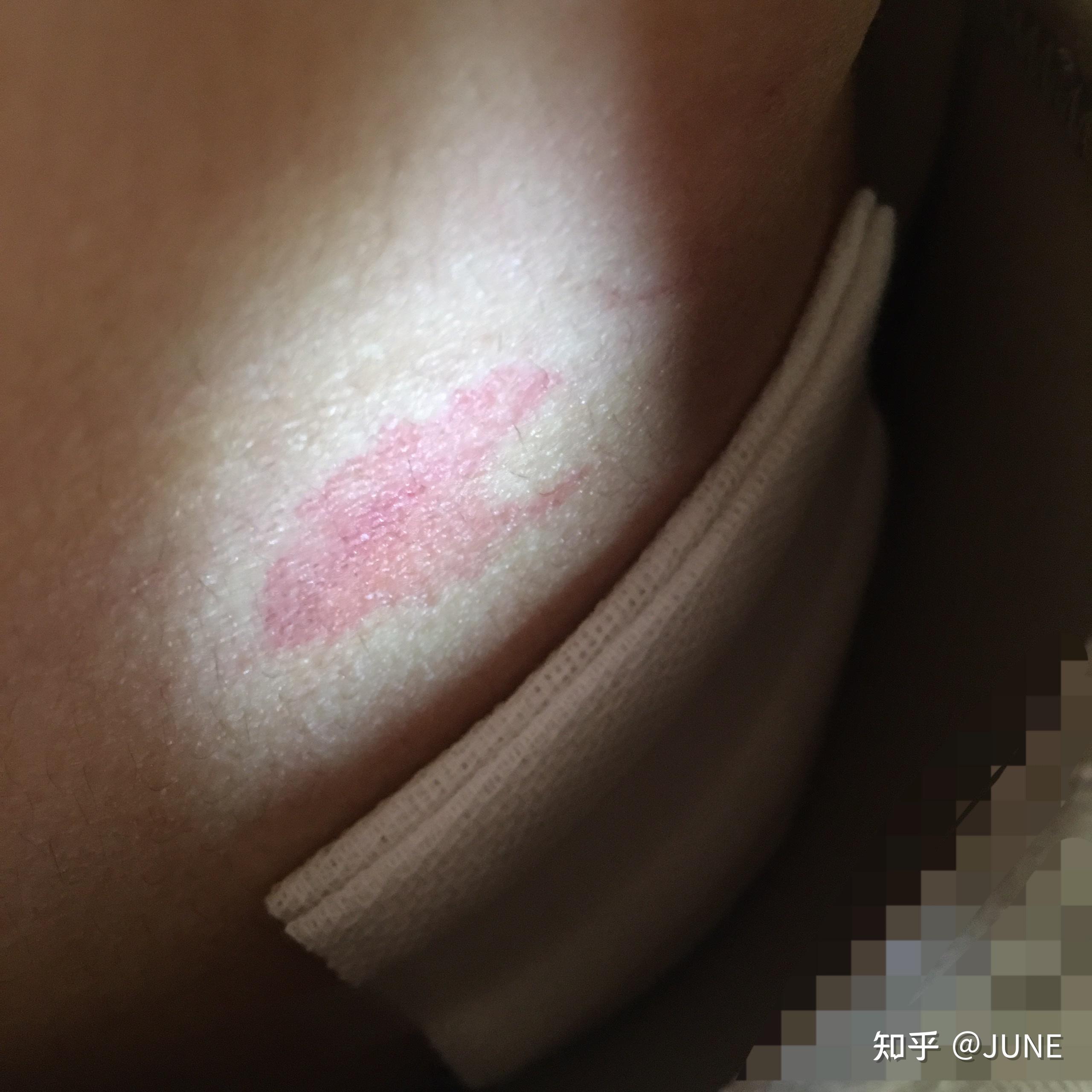 乳腺纤维瘤手术后疤痕图片