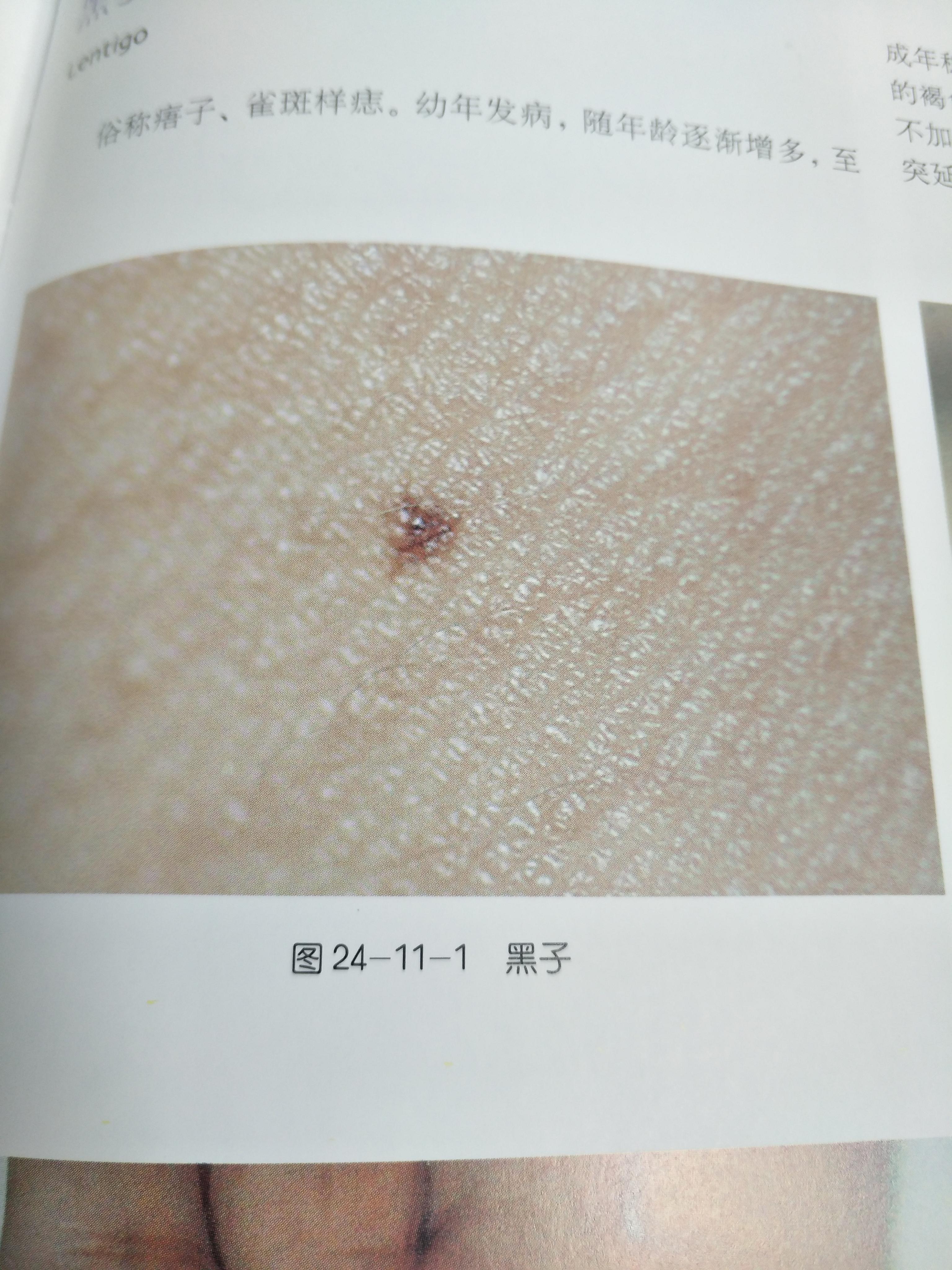 如何去除脸上的黑色素