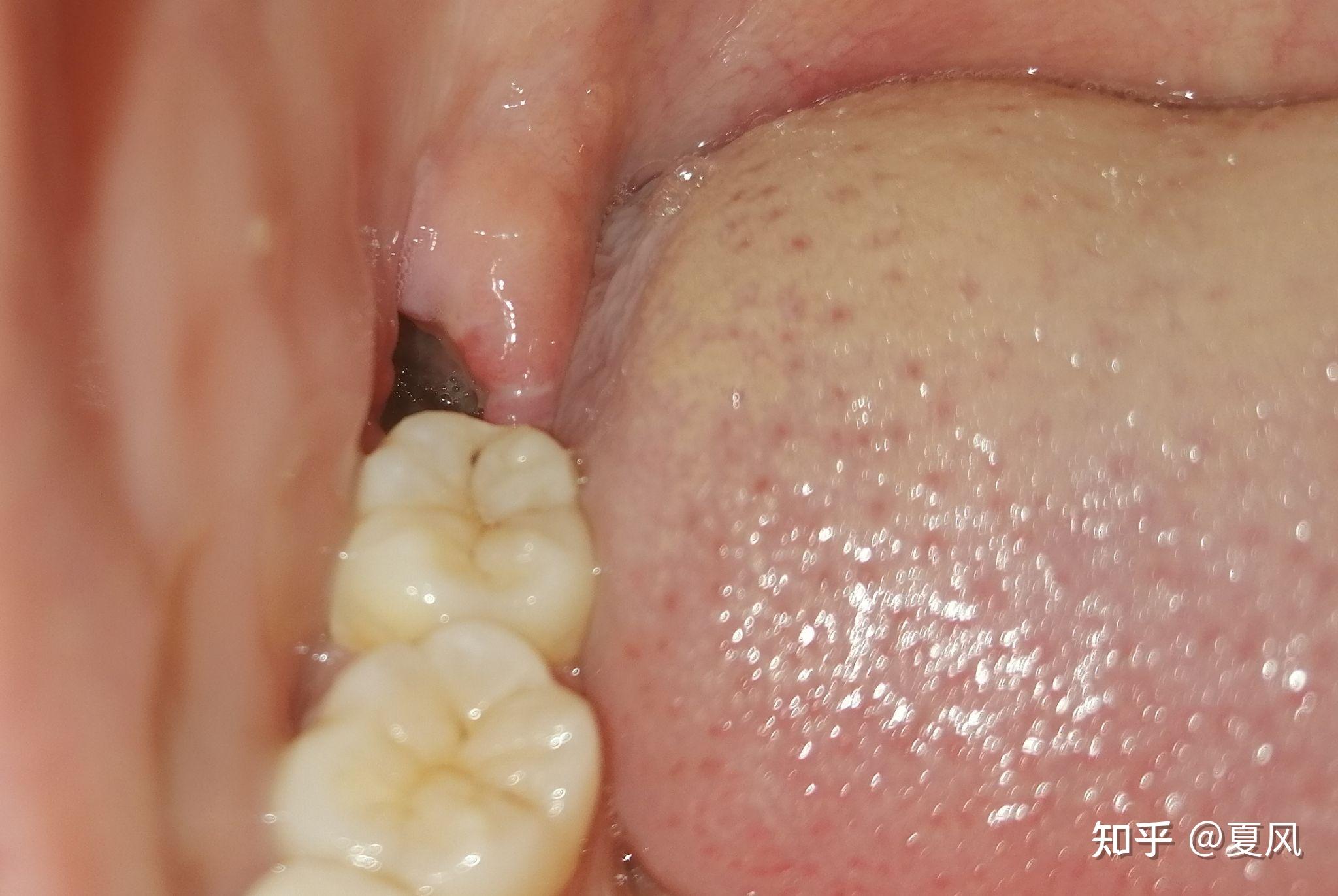 拔完智齿以后口腔缝合拆完线怎么有个洞? - 知乎