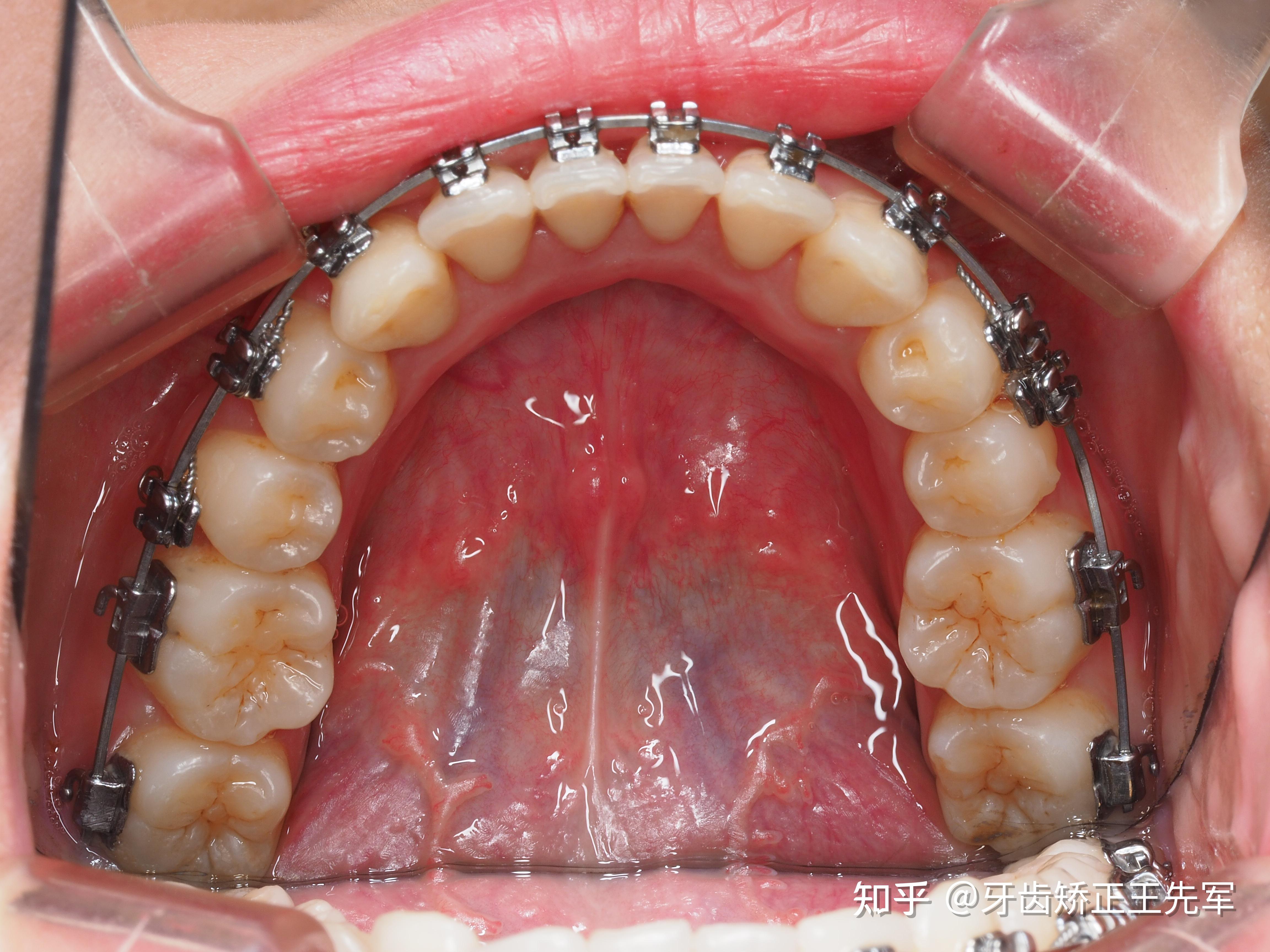 苏州牙齿矫正进口托槽自锁牙套矫正案例分享