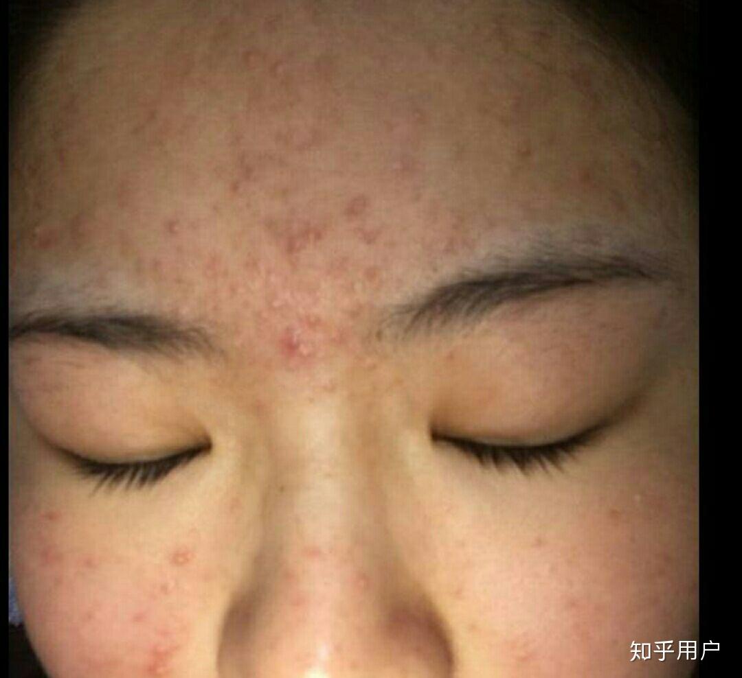 长期使用维a酸乳膏涂全脸会有什么后果