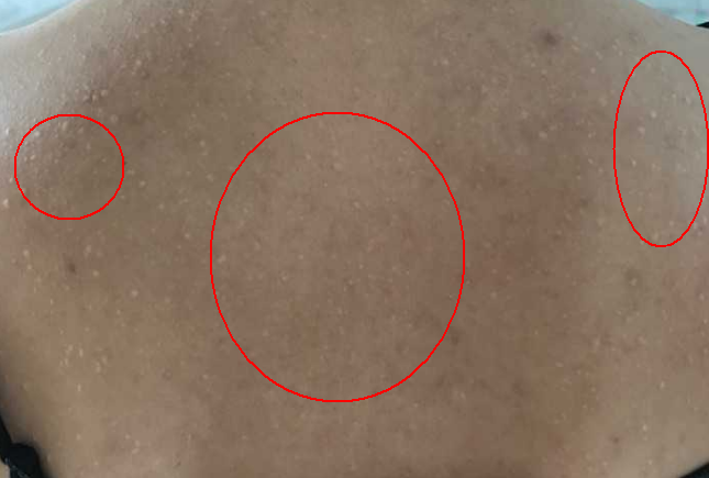 想问下背上这是白头粉刺还是脂肪粒,用什么产品治疗?