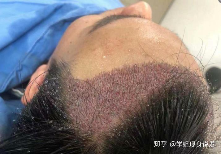 替发植发(不替发植发)