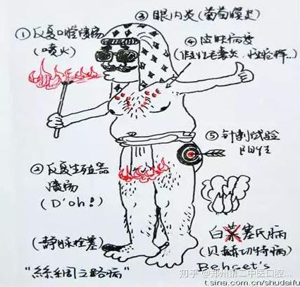 白塞氏病怎样治疗白塞氏病的治疗方案