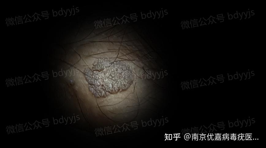 男性生殖器系带处长肉是不是尖锐湿疣? - 知乎
