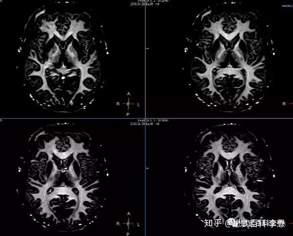 虽然这个序列叫双反转,其实无论是脑灰质成像,还是脑白质成像,脂肪