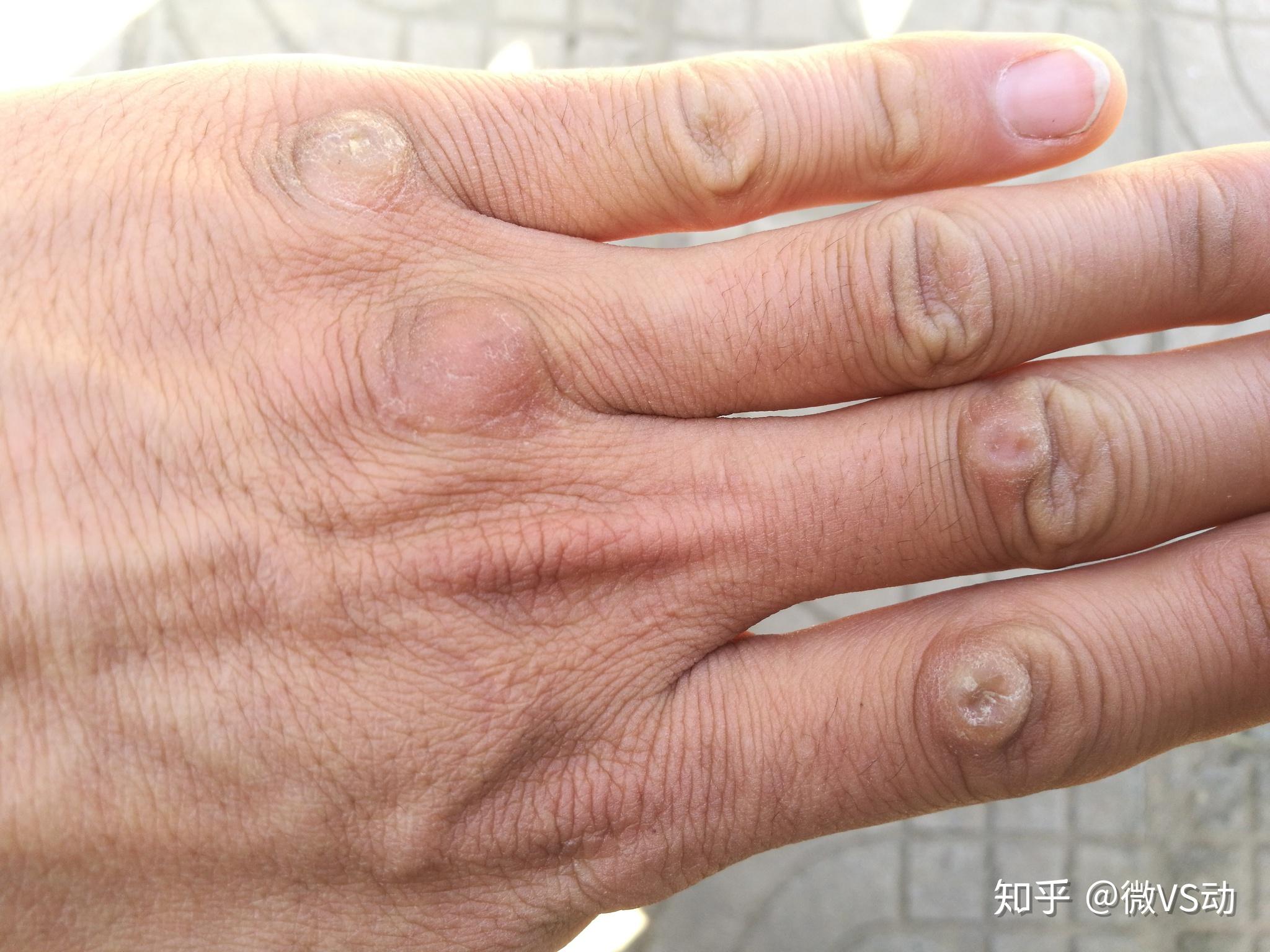 大家的拳茧都啥样了想见见