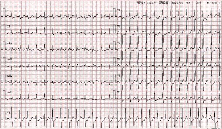 阵发性房性心动过速图片