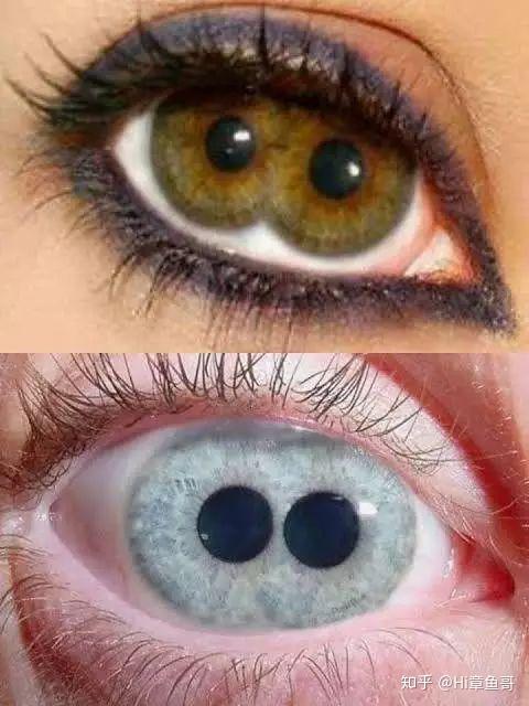 人类5种罕见的瞳孔图片