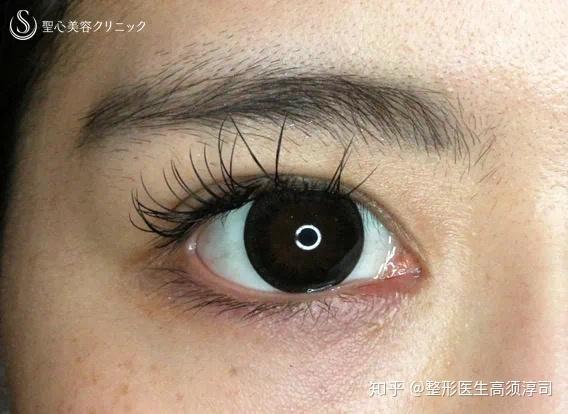 眼睛横向放大必备手术内眼角切开