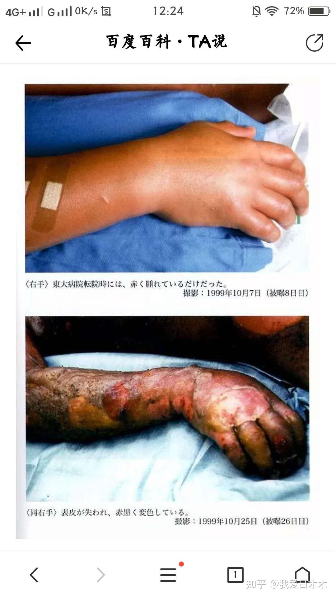 被超大剂量γ射线照射短时间内致死的人会有那些征象? - 知乎