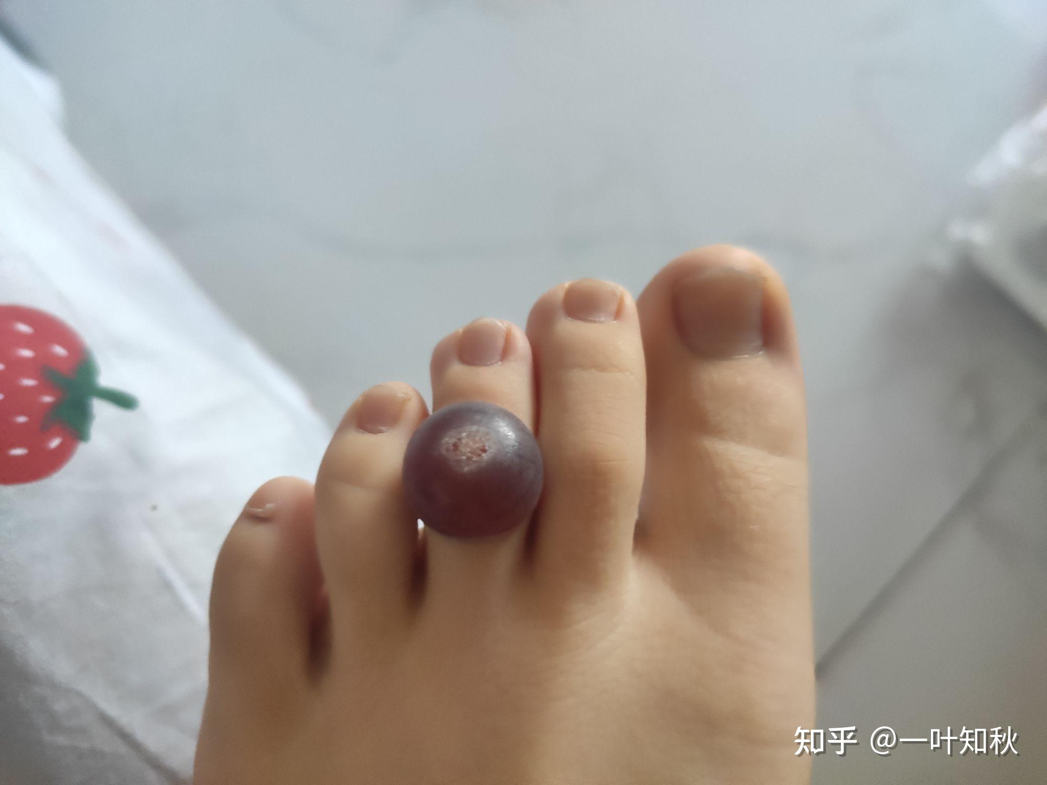 液氮冷冻治疗后手指上出了血泡而且越来越大该怎么办? - 知乎