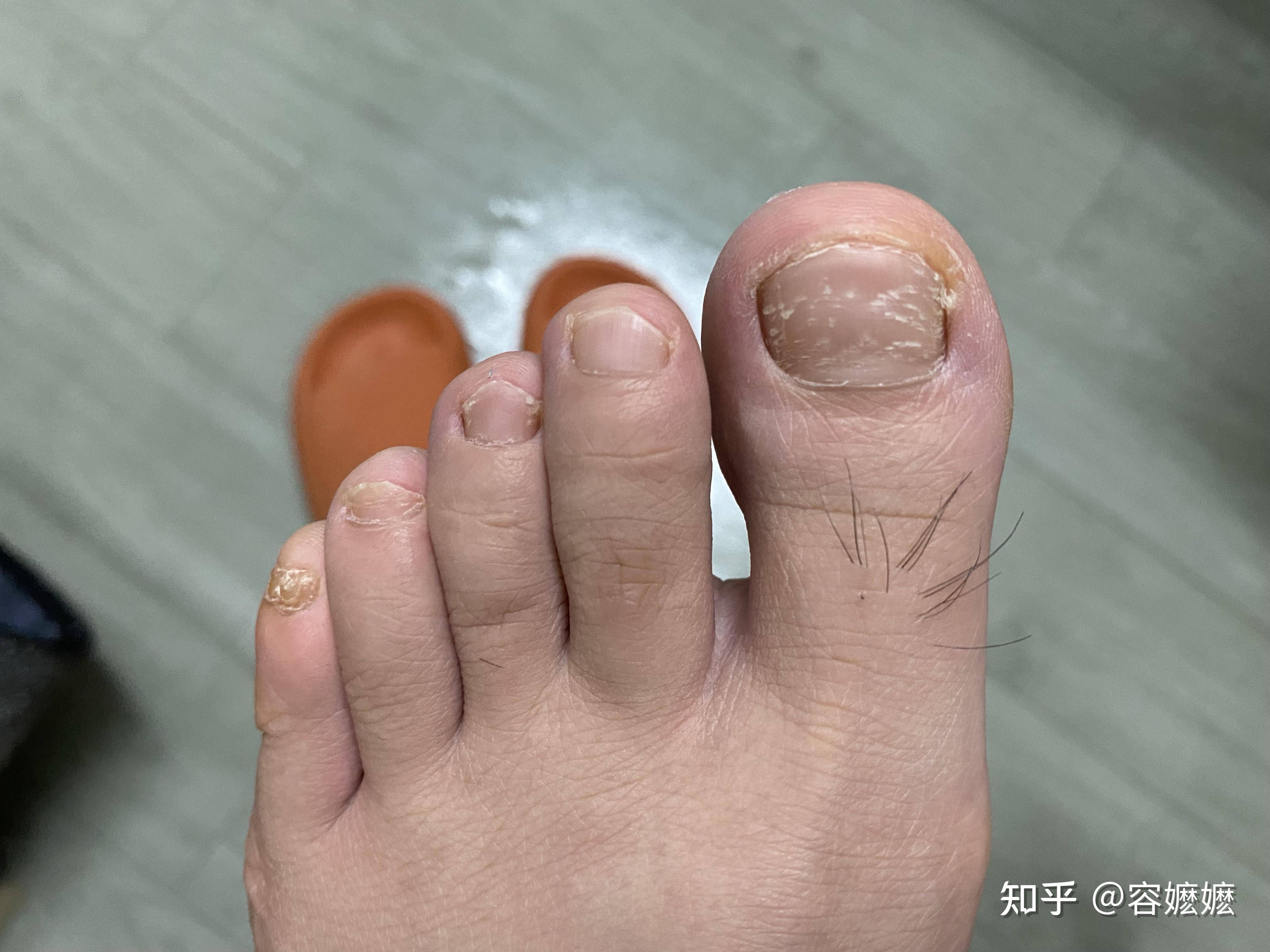 女生得了灰指甲怎么办? - 知乎