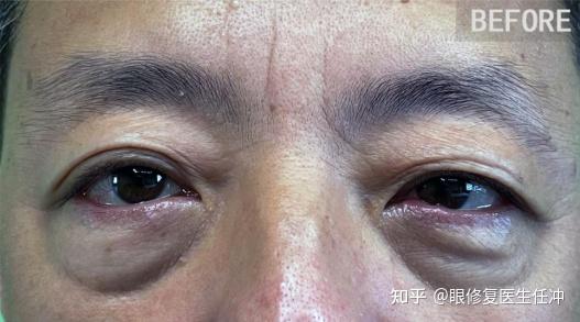 千万别被骗了男士不去眼袋无所谓他用亲身经历说出真相
