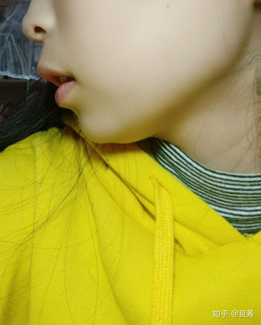 口呼吸造成嘴凸本人已成年改掉口呼吸可以有效的改善嘴凸吗