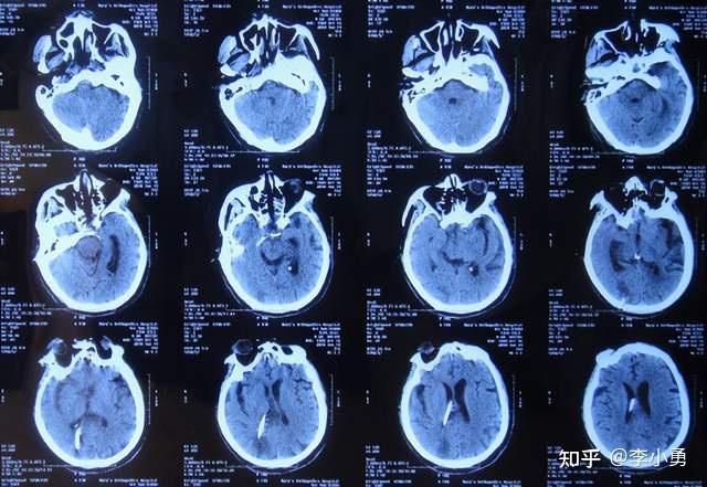 垂體瘤術後腦脊液漏,請北京專家再經鼻補漏後雙眼失明腦積水並顱內