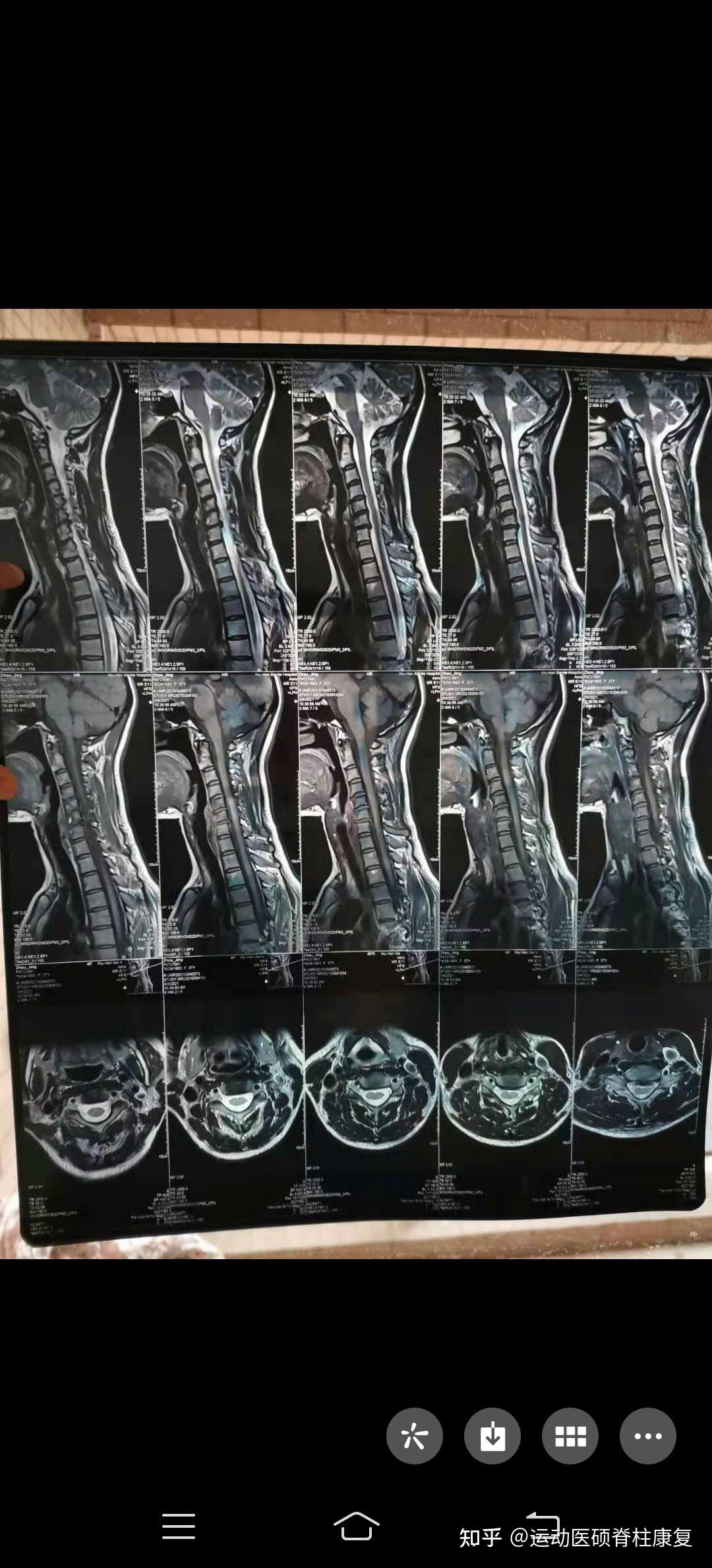 常见颈突错误训练