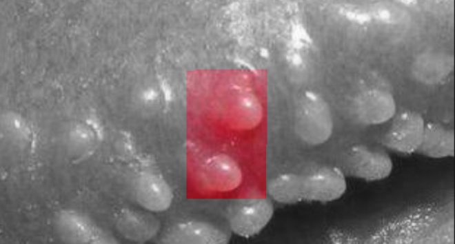 珍珠疱疹症状图片图片