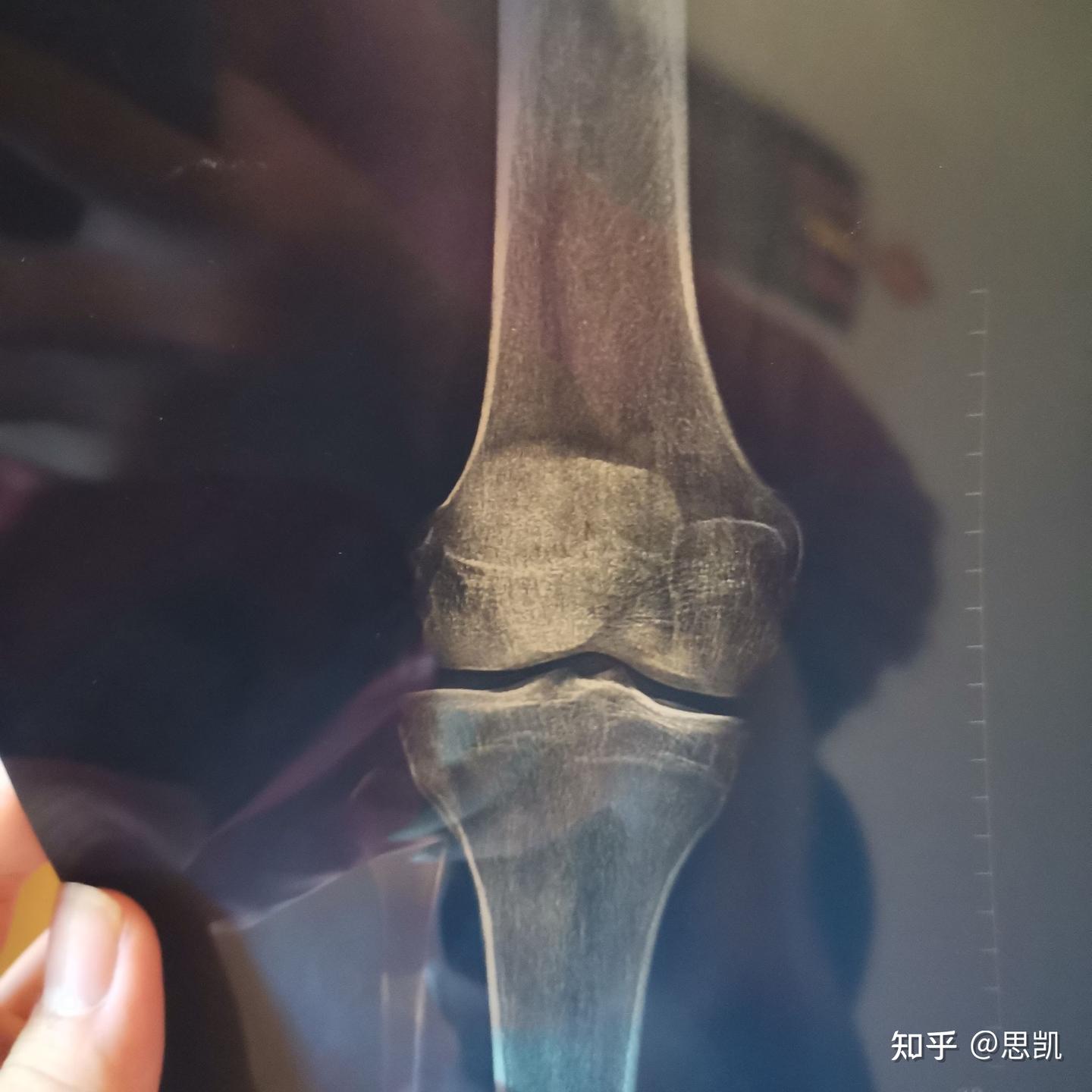 骨骺线闭合了吗？ - 知乎