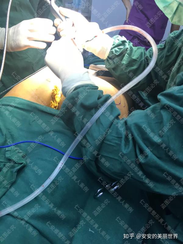 将臀部分为上中下三部分,先根据人体黄金比例在臀部中央植入假体,打造