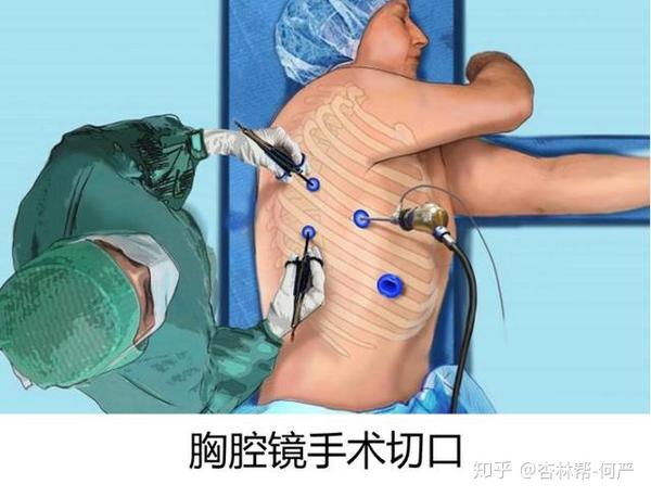 surgeon156 開胸術