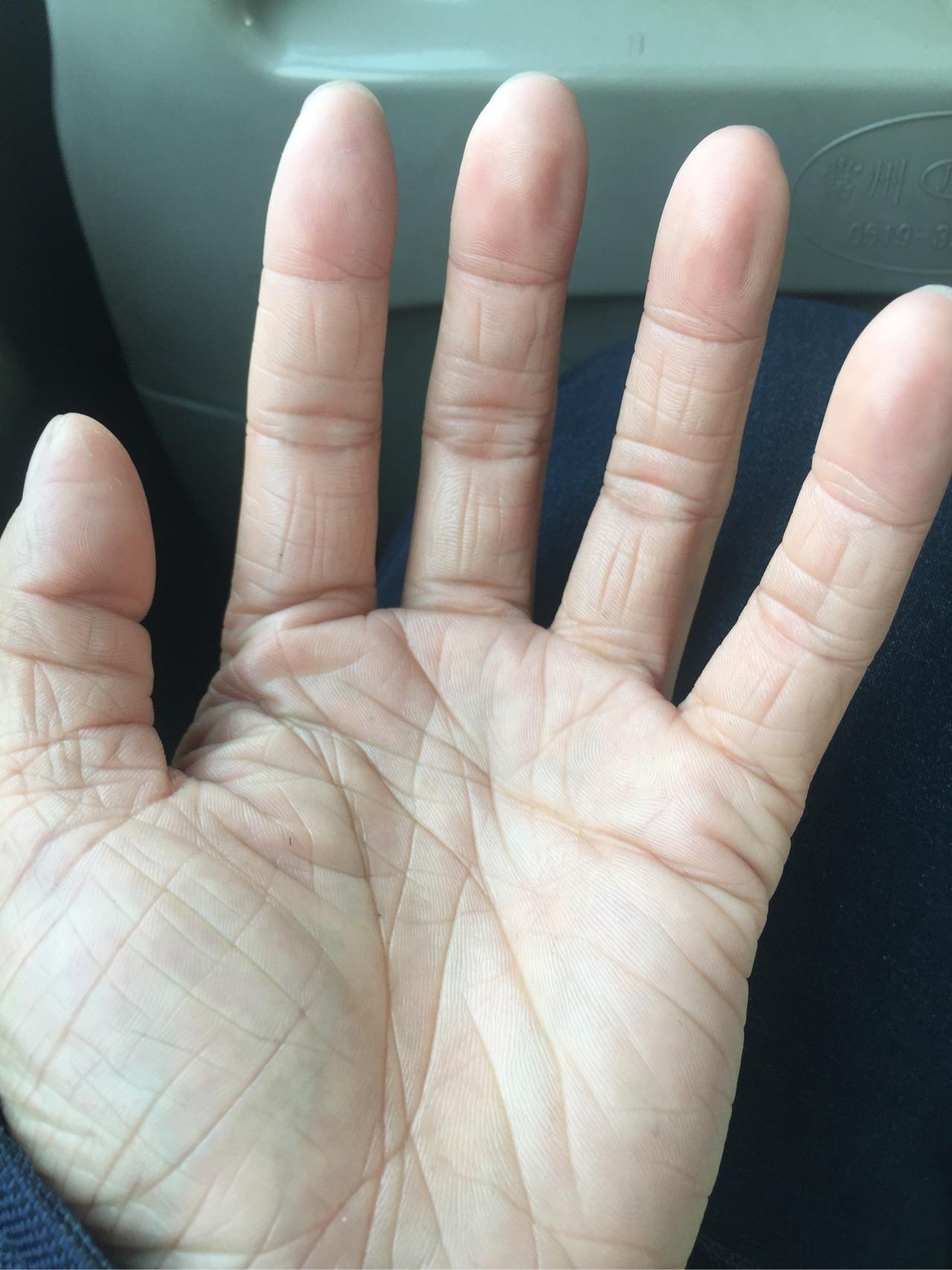 年纪轻轻23岁手上皮肤就很干有很多皱纹像老年人干瘪的手怎么办呀