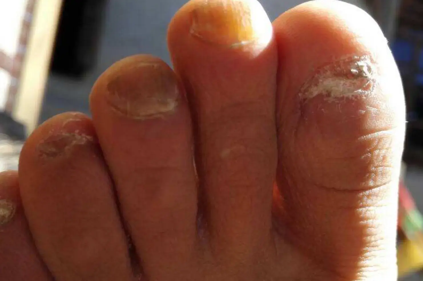 脚大拇指灰指甲初期怎么治疗,指甲盖变色发黑? - 知乎