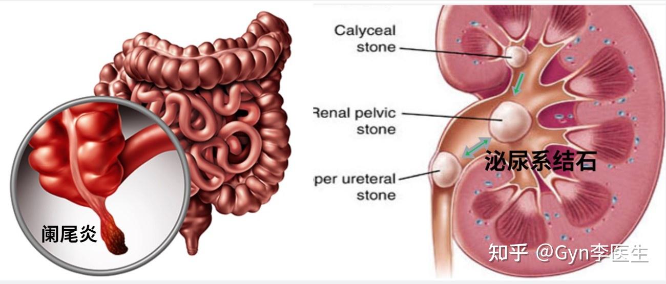 01 阑尾炎–01 泌尿系结石01 急性膀胱炎01 腹部创伤01