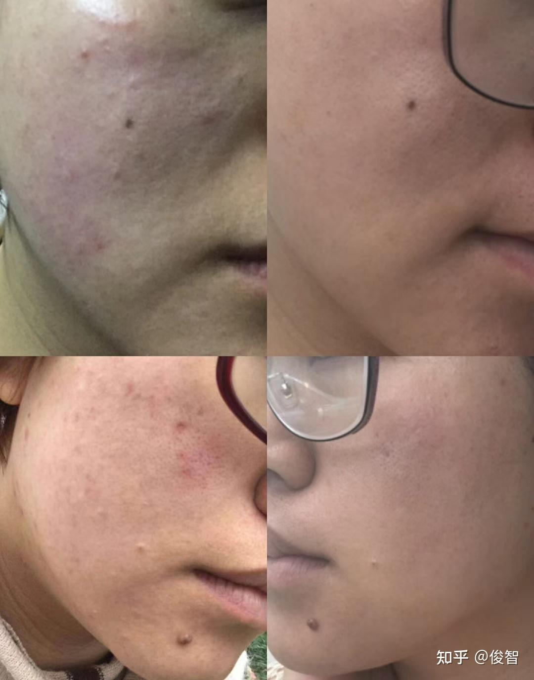 敏感皮肤烂脸修复方法