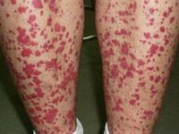 过敏性紫癜的诊疗误区