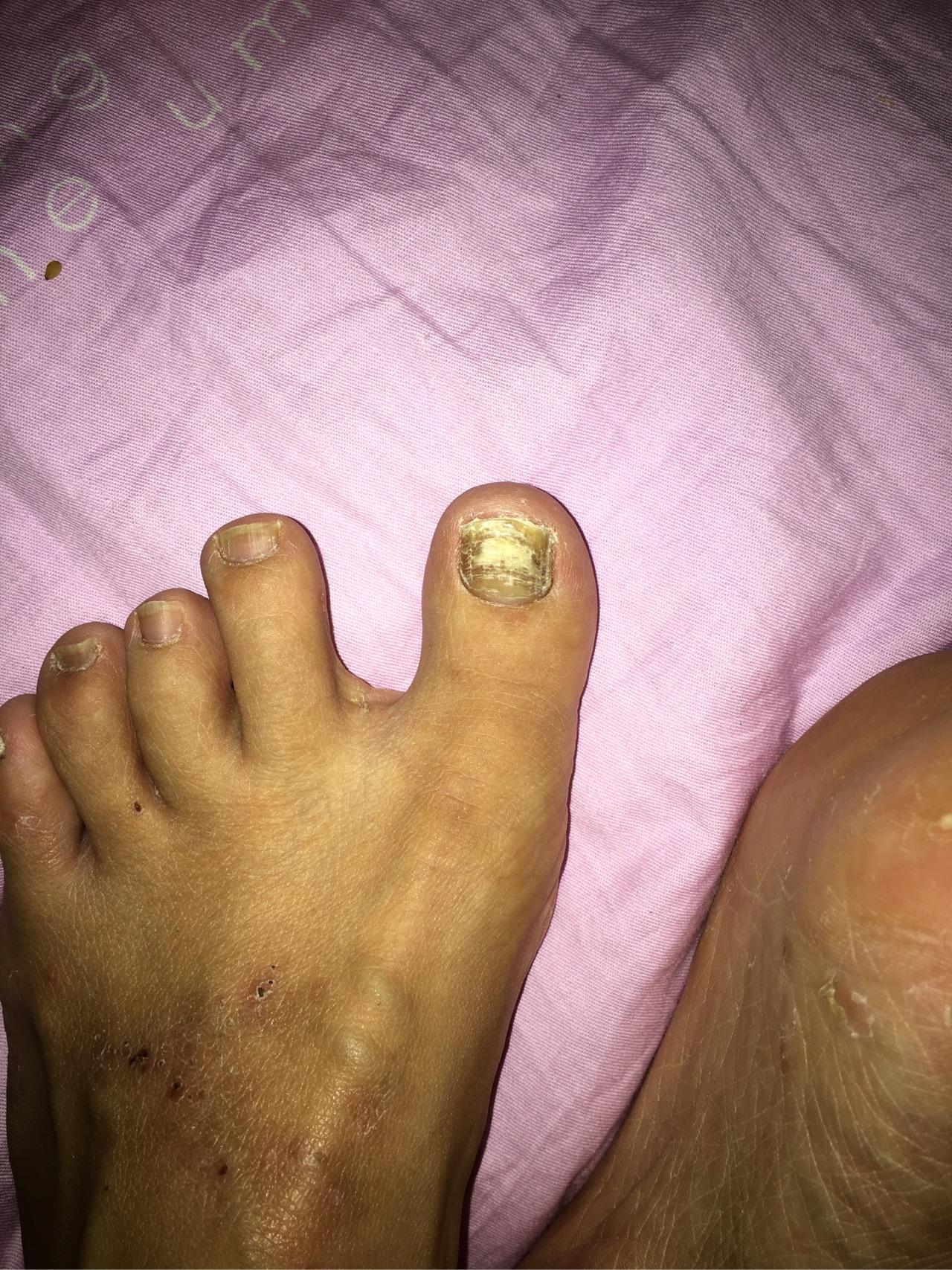 灰指甲的战斗内附照片介意的慎入谢谢