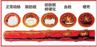 动脉硬化、粥样硬化、斑块有何不同,应如何调理! - 知乎