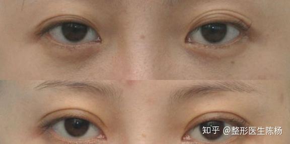 失败双眼皮的症状表现有哪些 修复方法及最佳时间是 知乎