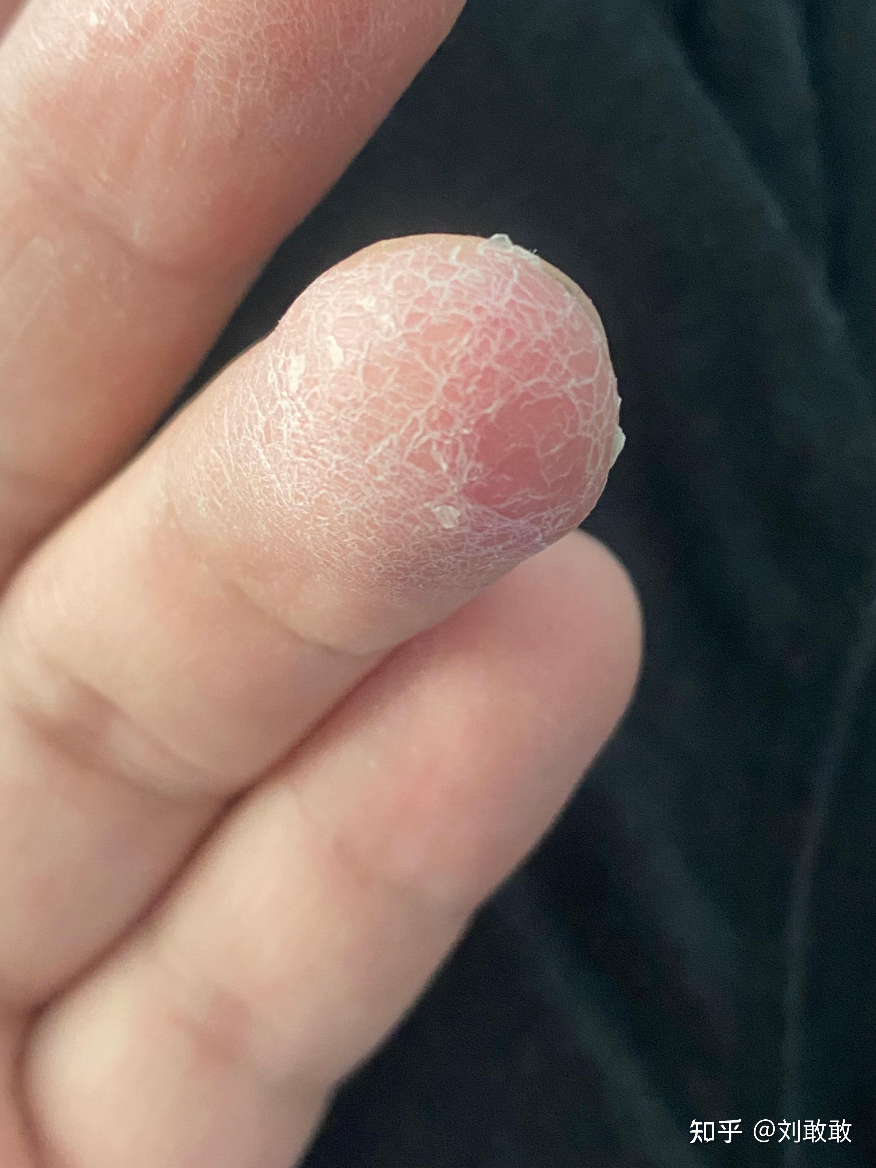 手指头反复脱皮,之前去过医院检查出剥脱性角质松懈症,开了维生素和