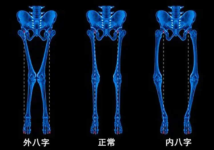 八字腳,分為內八字和外八字,都是因為足部錯誤受力所致,外八字腳為