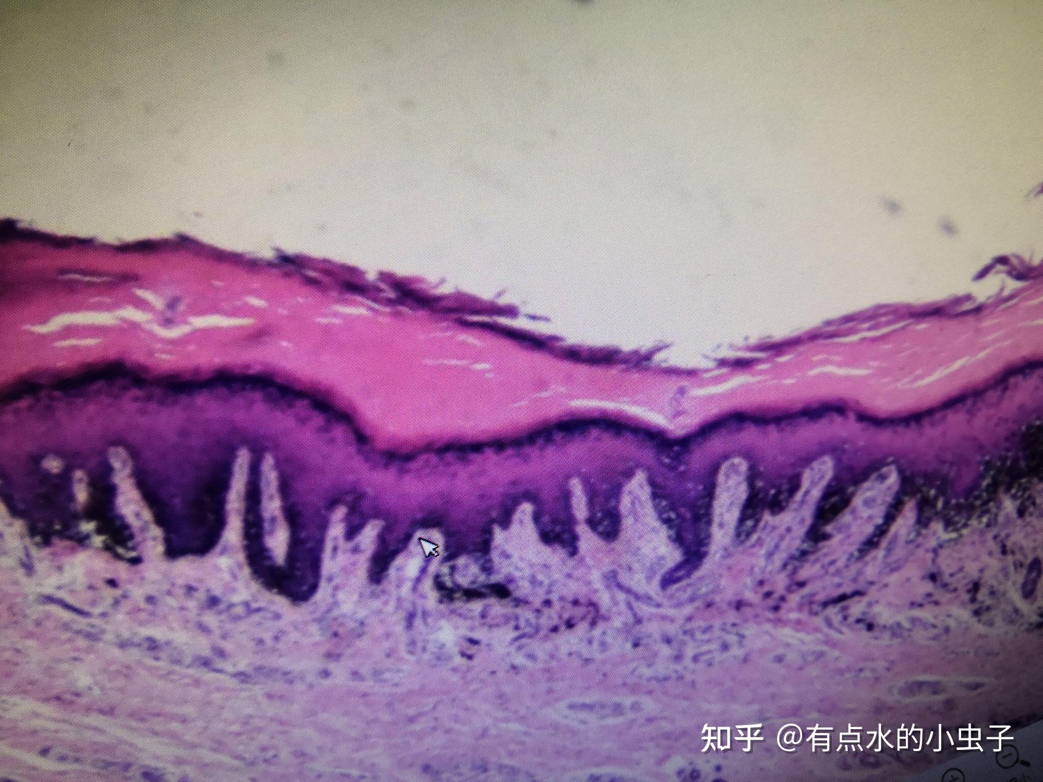 惡性黑色素瘤小腸出血性梗死肺出血性梗死慢性肝淤血慢性肺淤血異物