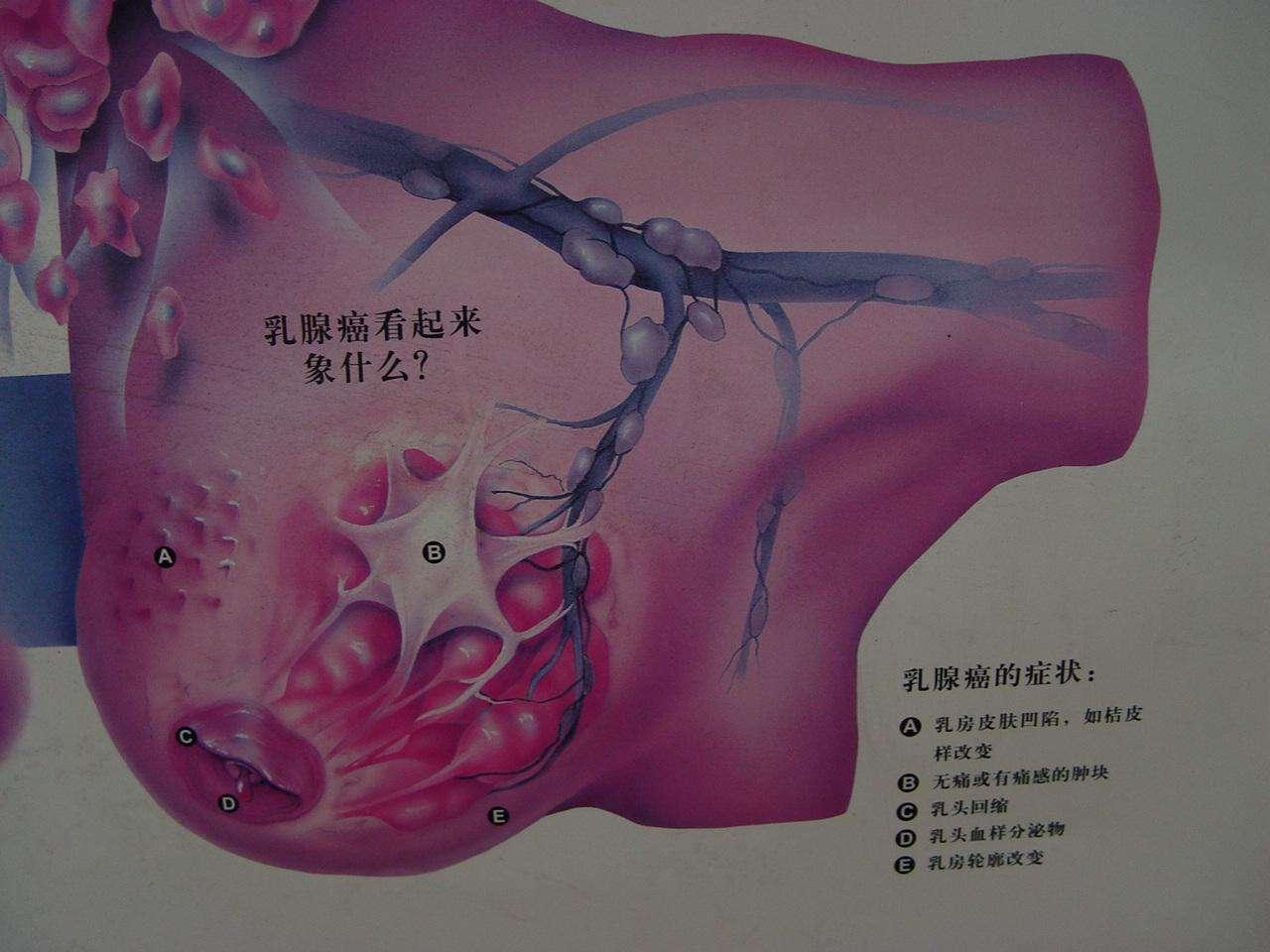 乳腺癌治療過程中心態很重要