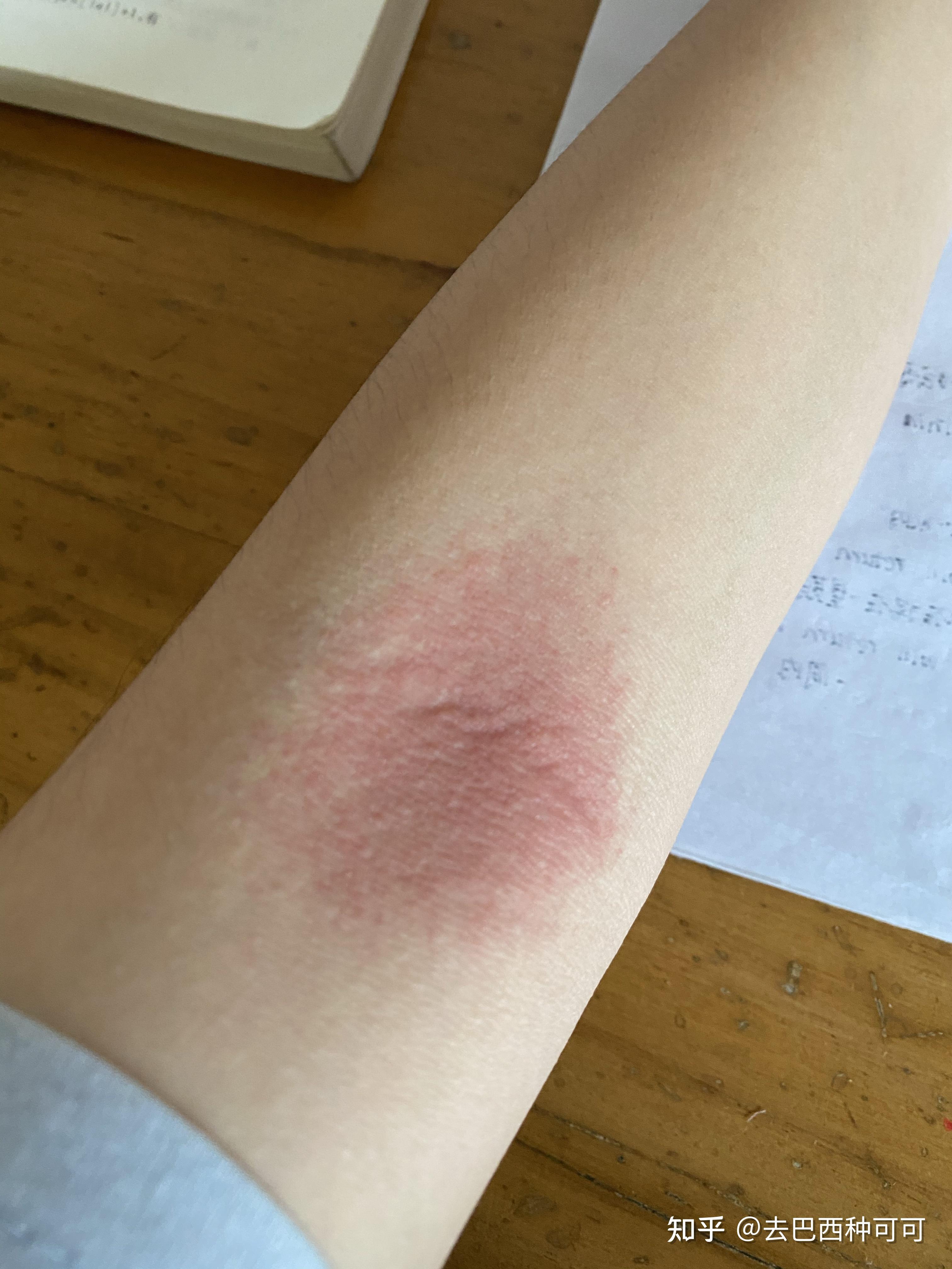 拍打手肘窝真的可以排毒吗